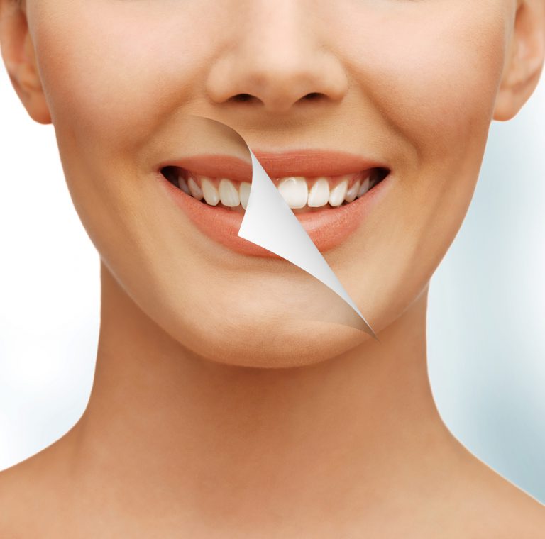 Como funciona o clareamento dental?