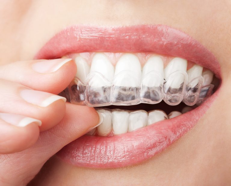 Conheça os diferentes tipos de aparelho dentário