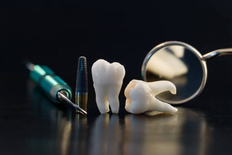 Implante dentário: saiba qual é o ideal para você!