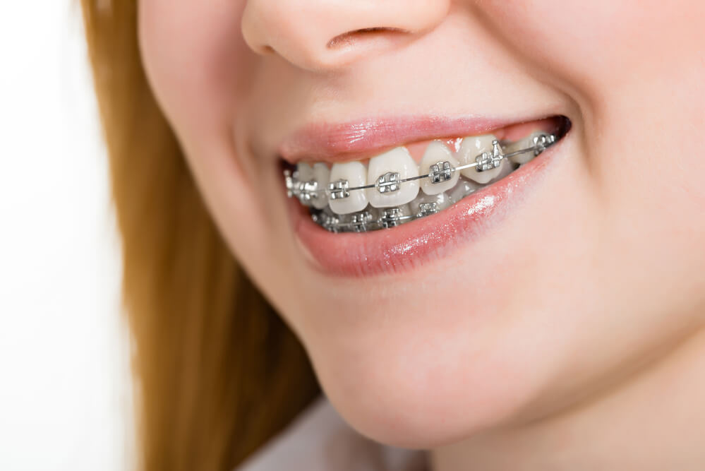 7 mitos sobre aparelhos ortodonticos, caries e clareamento