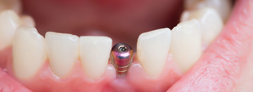 vantagens de realizar implante dentário parcial fixo