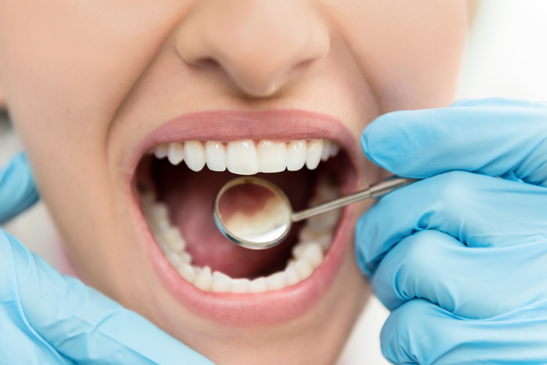 Como recuperar o esmalte do dente - Sorridents