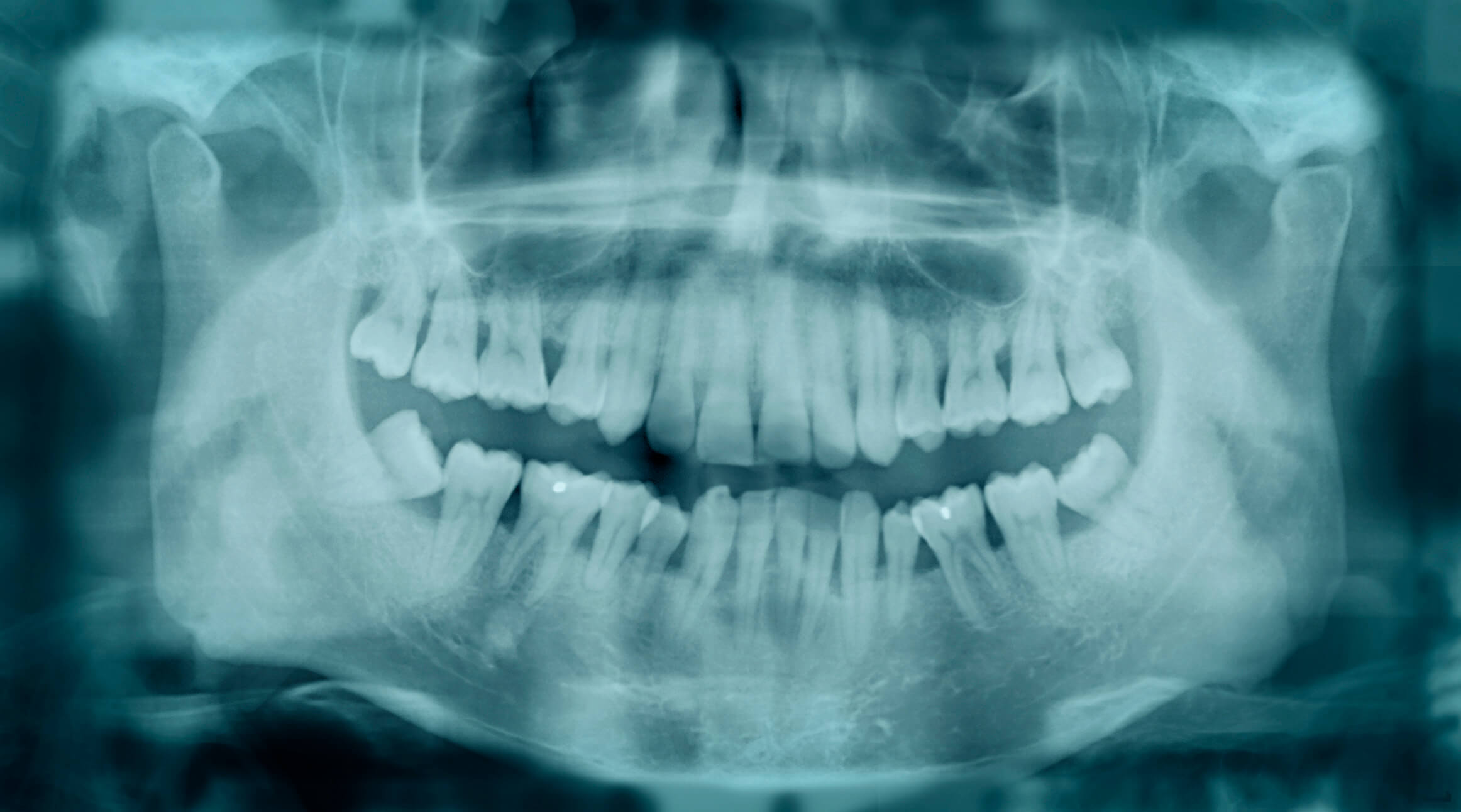 Featured image of post Fotos De Dente Entramelado Daca in trecut unica varianta pentru substituirea unui sau mai multor dinti erau restaurarile dentare coronae punti