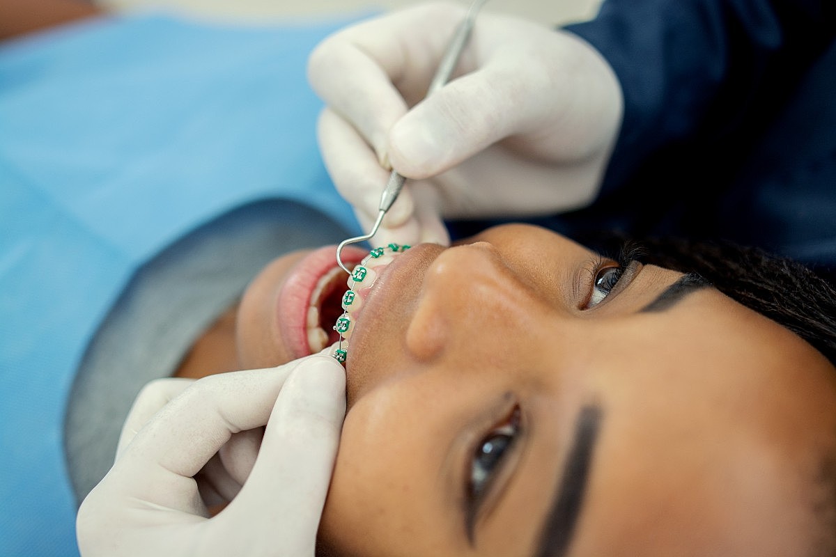 Manutenção do aparelho dental fixo: saiba tudo sobre essa etapa do